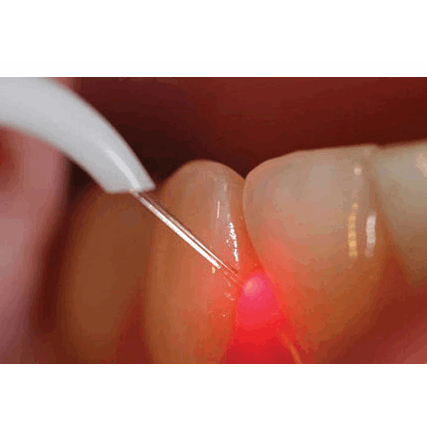 Laserbehandling i odontologien