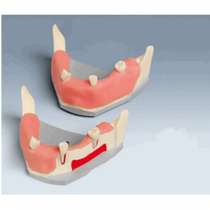 Frasaco Modell Implantat A-J F UKWA UK