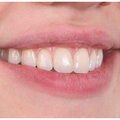 Kuraray - erstatning av misfargede kompositt fyllinger